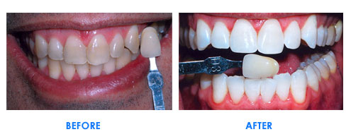 teeth_whitening
