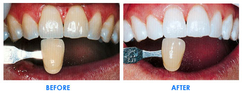 teeth_whitening
