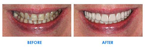 veneers