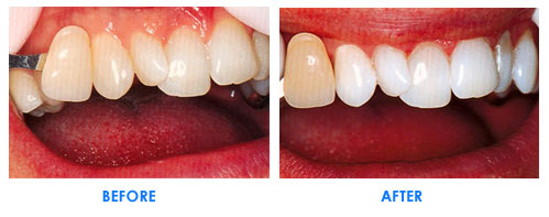 teeth_whitening