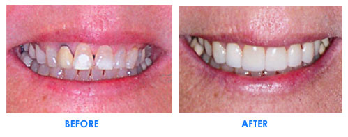 veneers