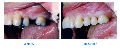 Puentes y Dentaduras