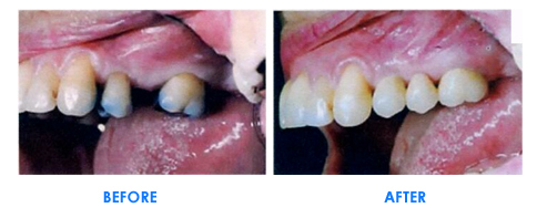 Bridges and Dentures