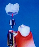Implantes