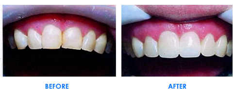 Laminate Veneers