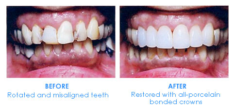 Porcelain Crowns