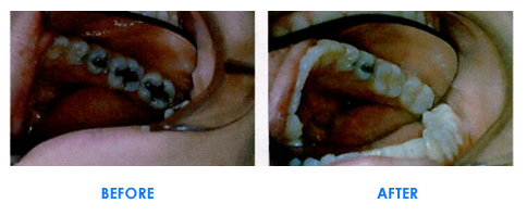 Porcelain Fillings