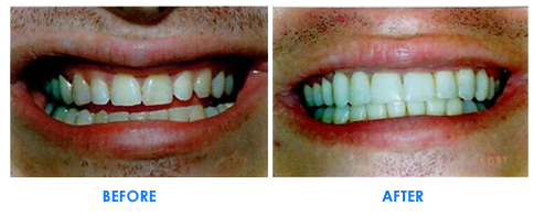 Porcelain Veneers