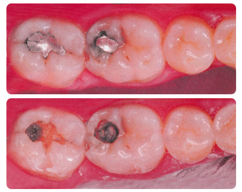 silverfillings