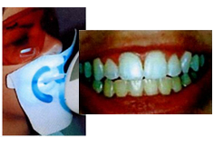 Blanquiamiento de Los Dientes