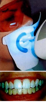Teeth Whitening