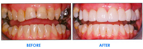veneers