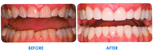veneers