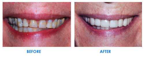 veneers