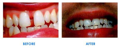 White Porcelain Fillings