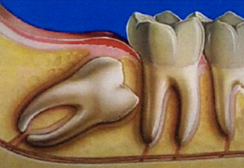 Cirugia Oral – Cordales