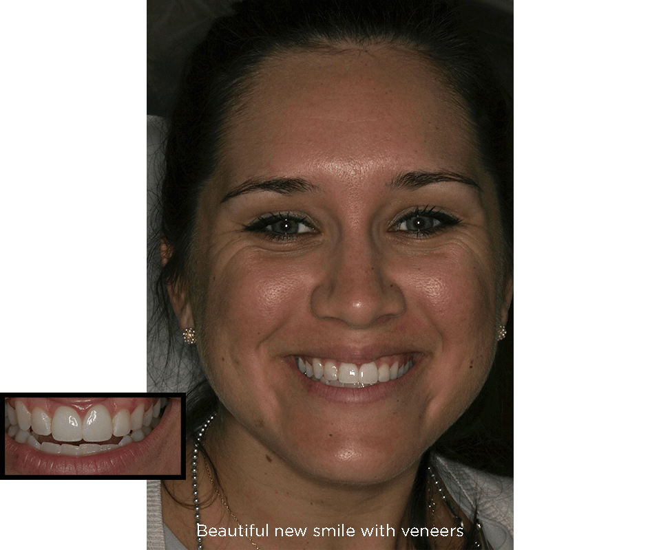 dientes frontales astillados después de tratamientos de carillas de porcelana