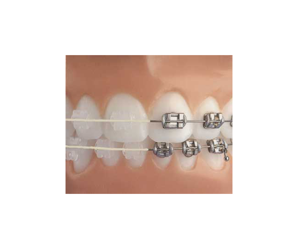 ceramic braces compared to metal braces
