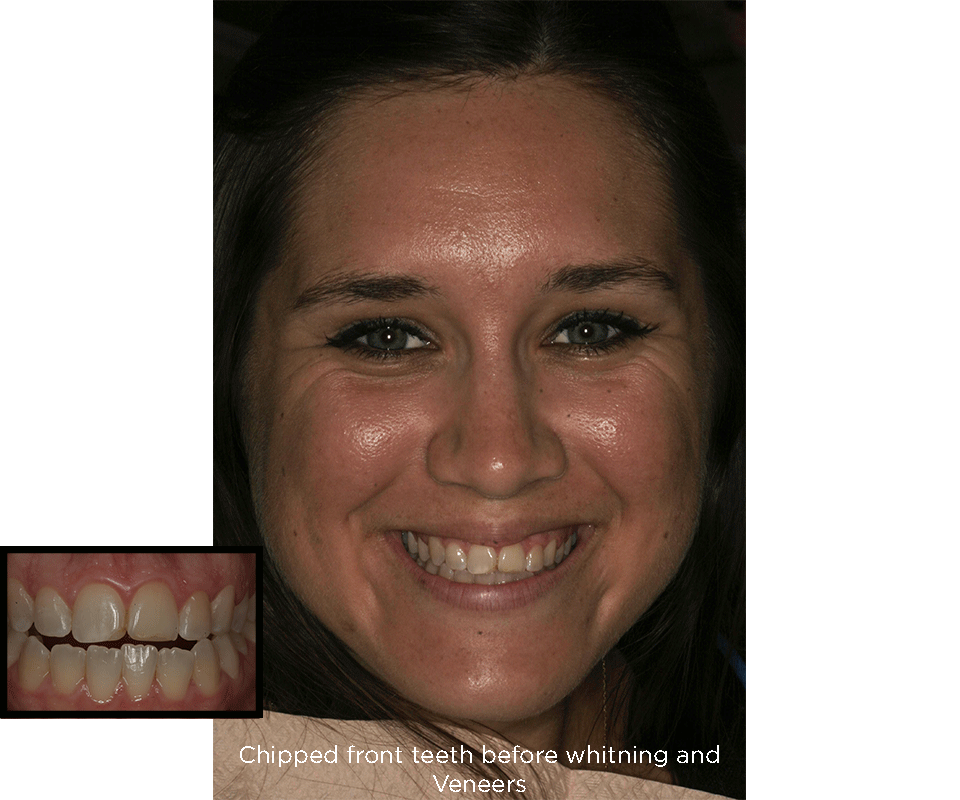 dientes frontales astillados antes de los tratamientos de carillas de porcelana