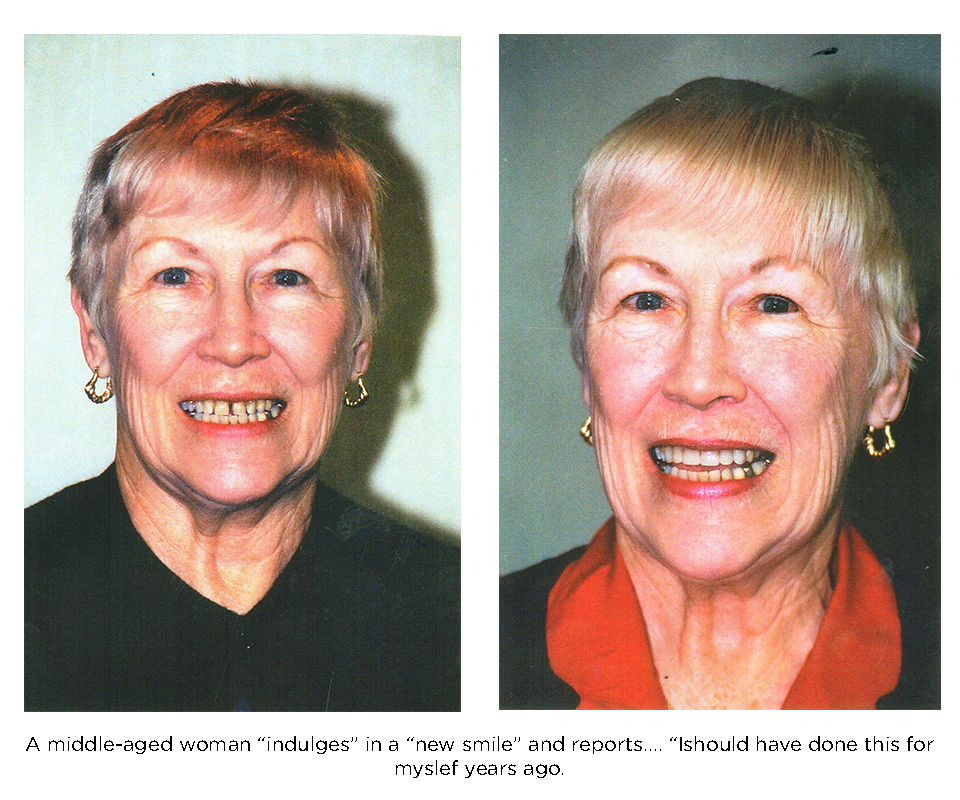 Mujer de mediana edad con una hermosa sonrisa nueva gracias al uso de carillas de porcelana