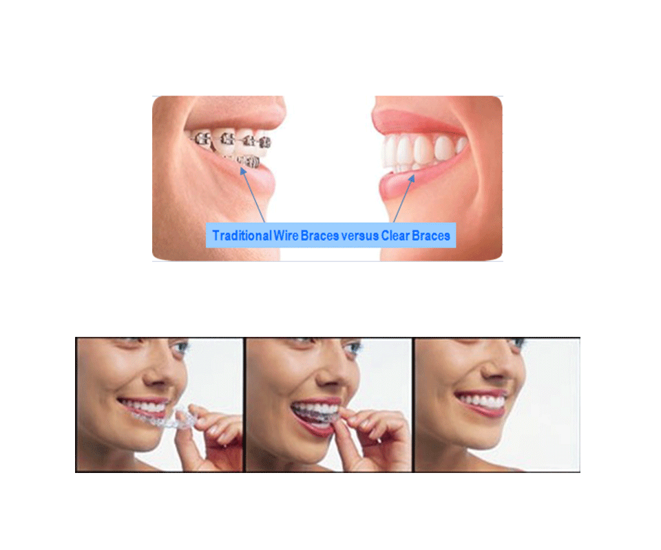 traditional wire braces vs clear braces