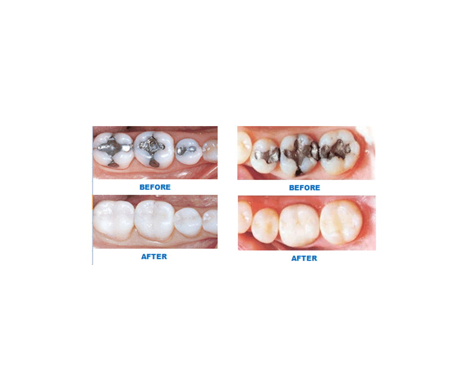 dental bonding before and after