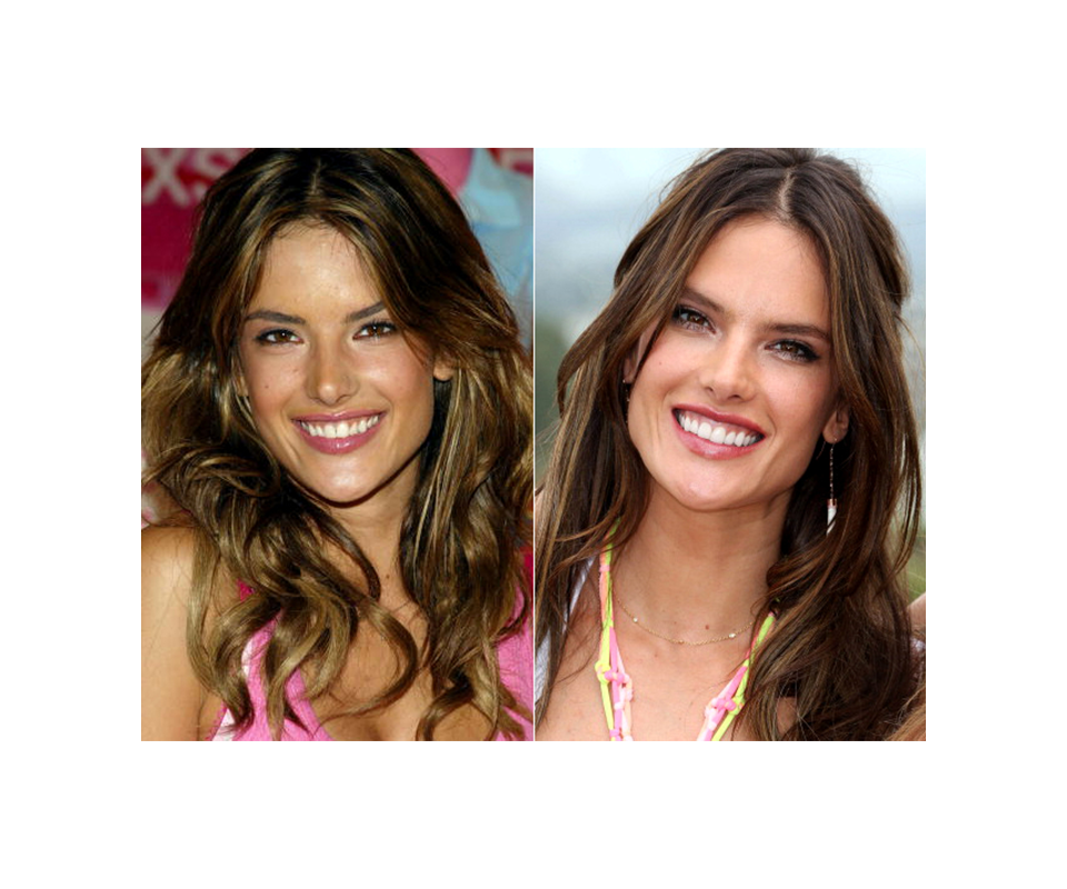 antes y después de las carillas dentales de celebridades