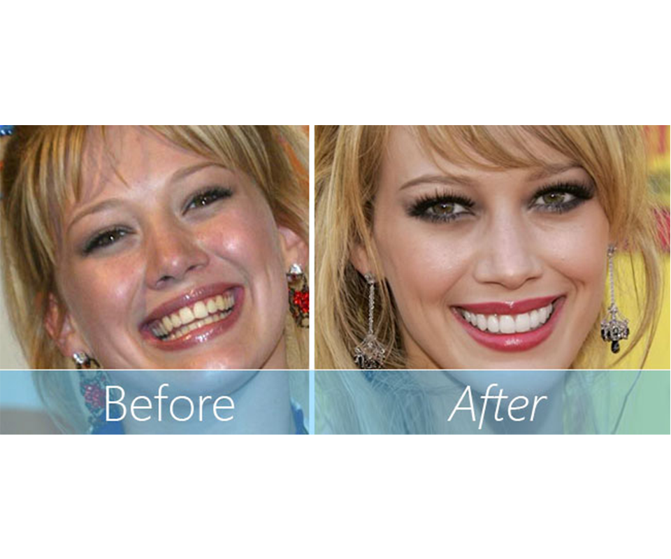 celebridad antes y después de la transformación de una hermosa sonrisa con carillas dentales