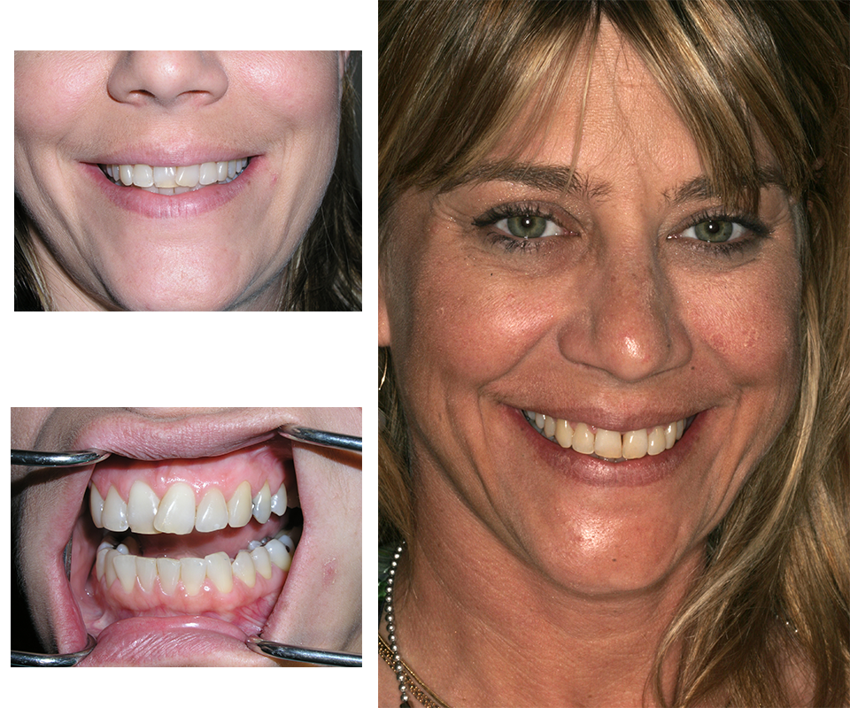 Adult Orthodontics using clear correct | Dr. Alvaro Fernandez-Carol Coral Gables