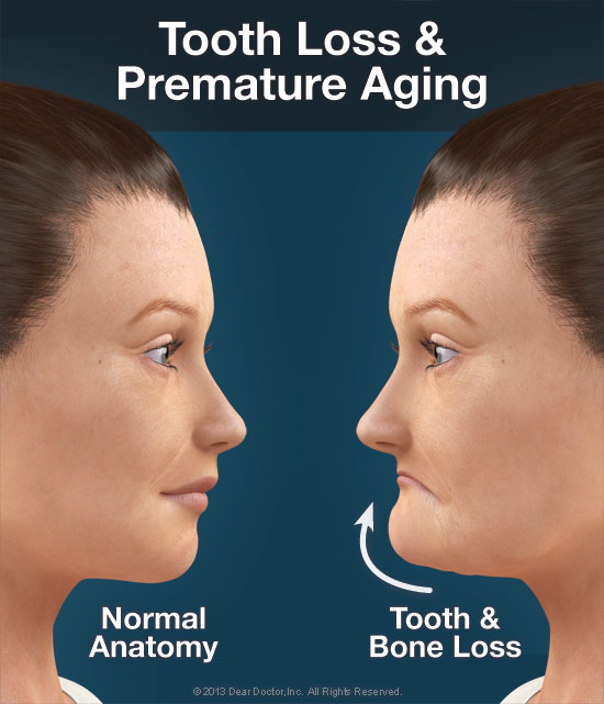 dental implants can help prevent pre mature aging due to tooth loss