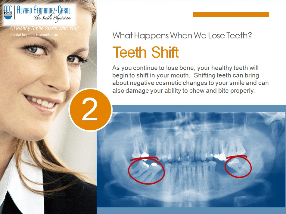 dental implants prevent teeth shift