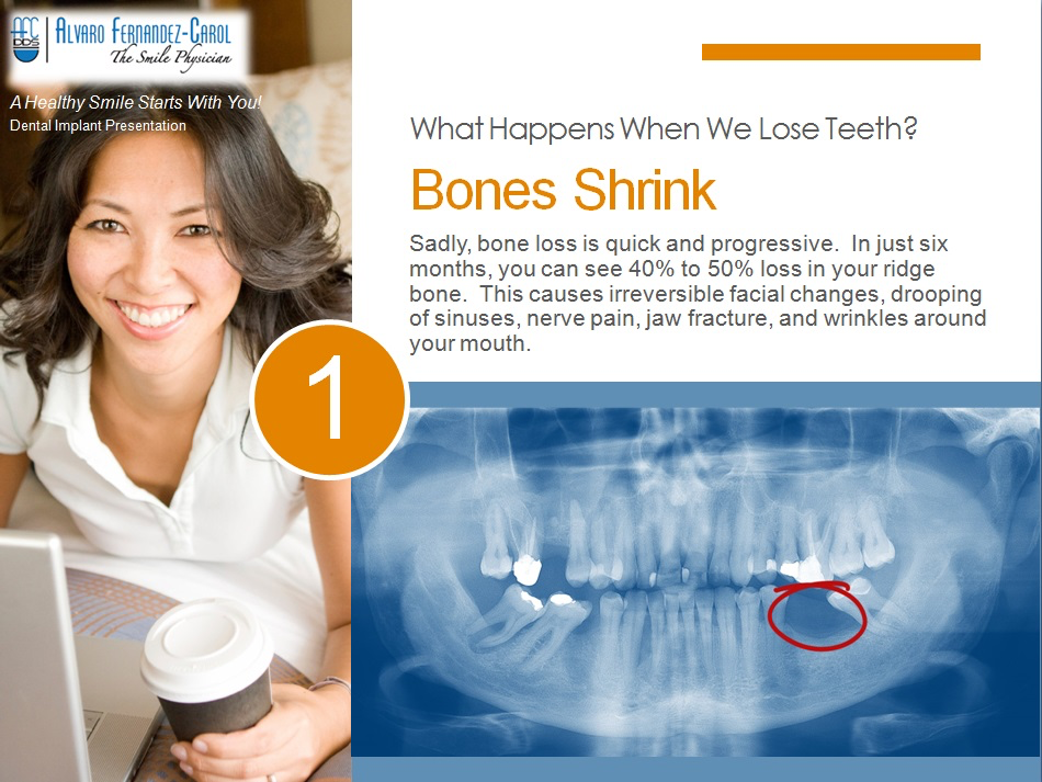 dental implants prevent bone shrink