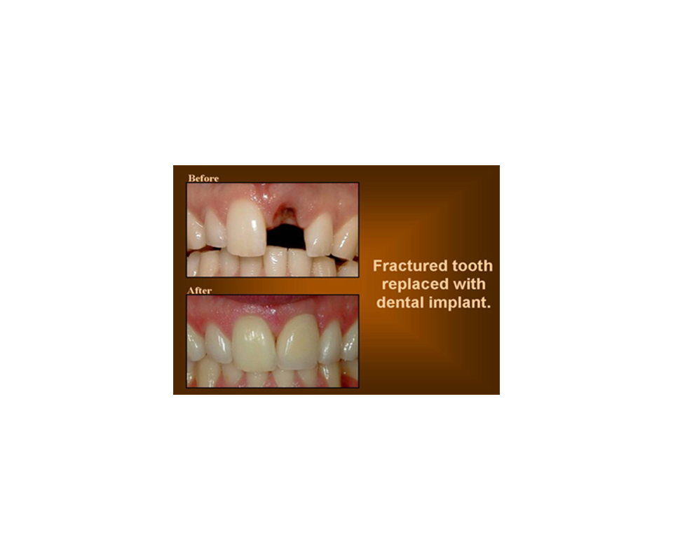 replacing a fractured tooth with dental implant