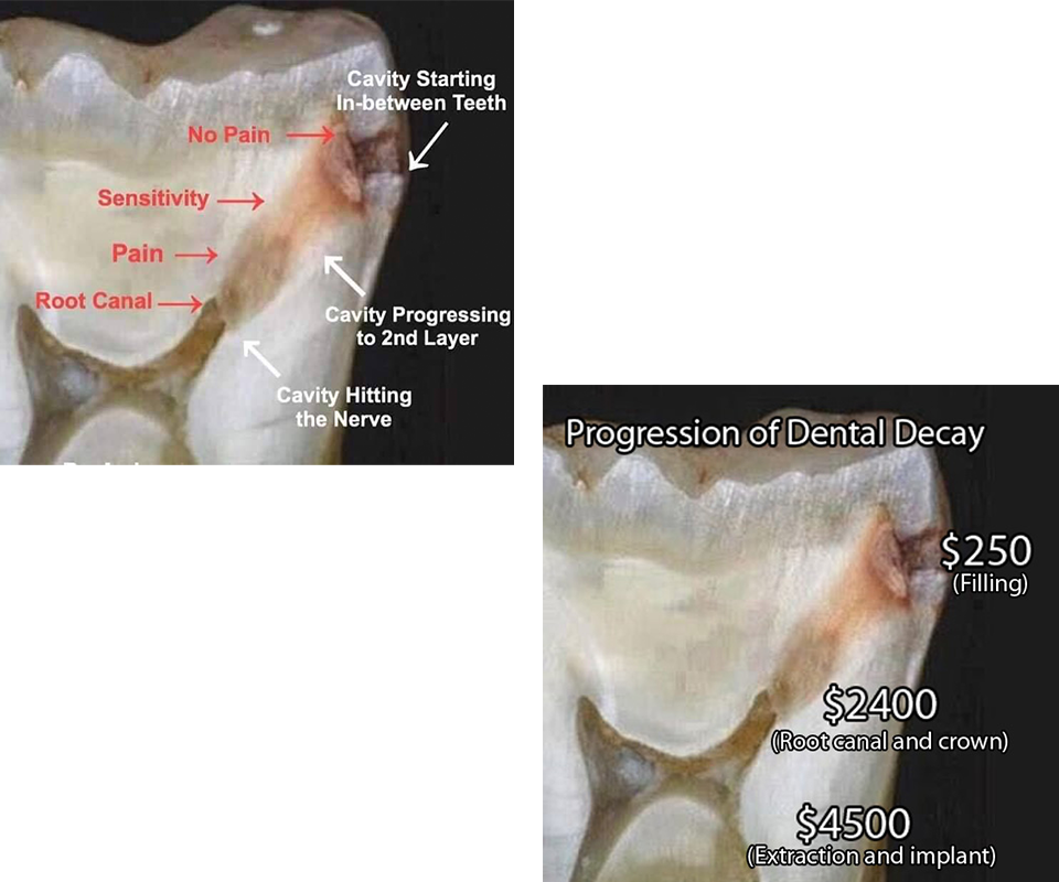 Progression of dentail decay and financial implecation of it