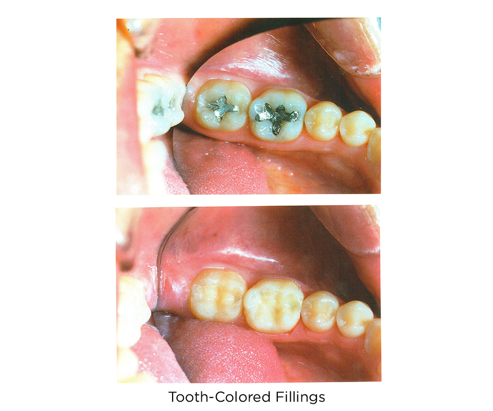 tooth colored filling